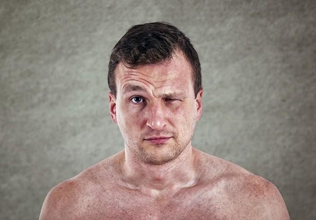 ‘Bell’s Palsy’ Akibat ‘Aircond’?