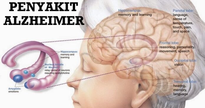 penyakit-alzheimer