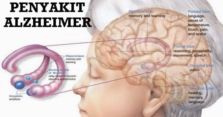 Penyelidik Temui Pautan Genetik Baharu Kepada Penyakit Alzheimer