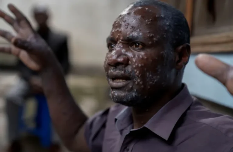WHO Isytiharkan Mpox Sebagai Kecemasan Kesihatan Awam Global