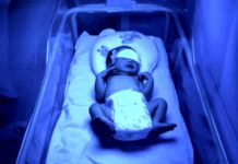 Susu Kambing Bukan Rawatan Untuk Kuning (Neonatal Jaundis)